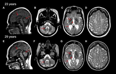 Biallelic pathogenic variants in POLR3D alter tRNA transcription and cause a hypomyelinating leukodystrophy: A case report